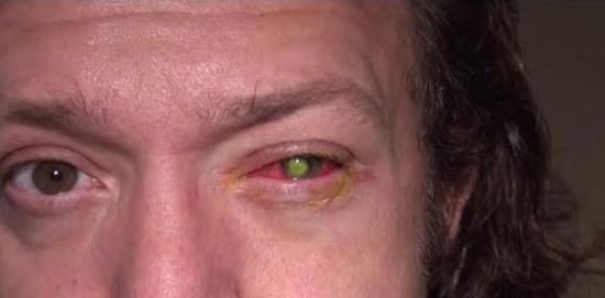 Man Goes Blind In One Eye By Doing Something You’re Probably Doing If You Wear Contacts